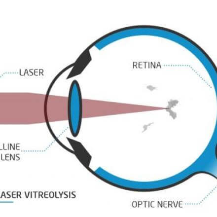 YAG Laser Vitreolysis For Eye Floaters
