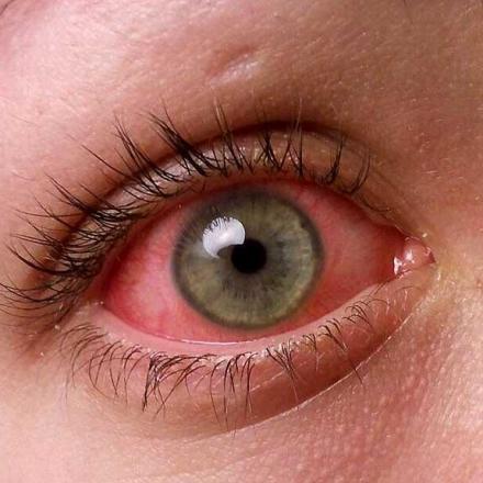 Causes of Pink Eye