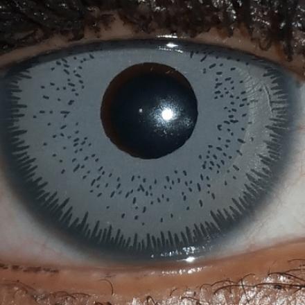 Eye color change surgery with cosmetic artificial iris implant