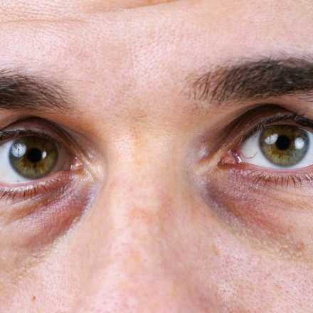 اسباب الهالات السوداء حول العين