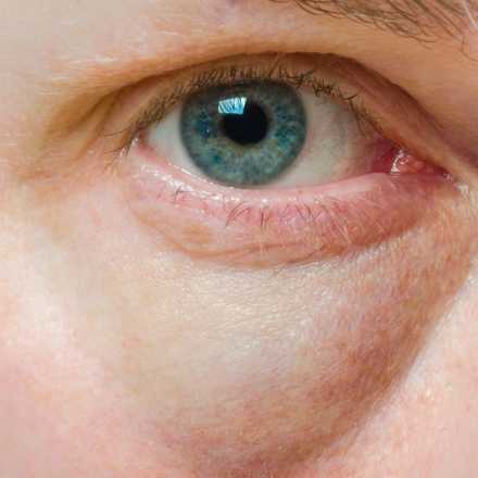 Home remedies for dark circles under eyes