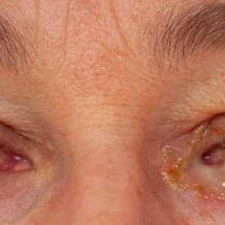 bacterial conjunctivitis in both eyes. Purulent discharge in left eye