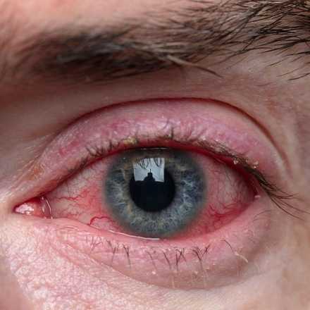 When should I be worried about red eyes?